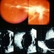 Pre-Retinal Fibrous Proliferative Membrane